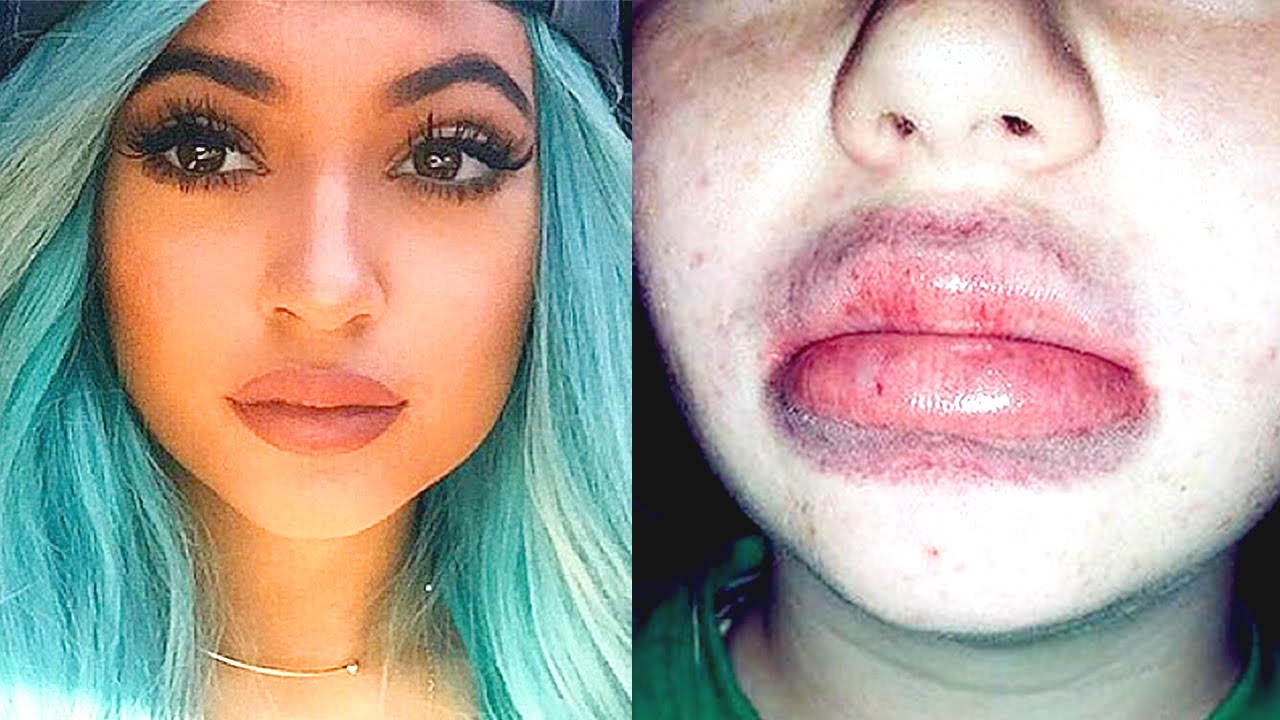 How To Get Giant Kylie Jenner Lips Like An Idiot! 