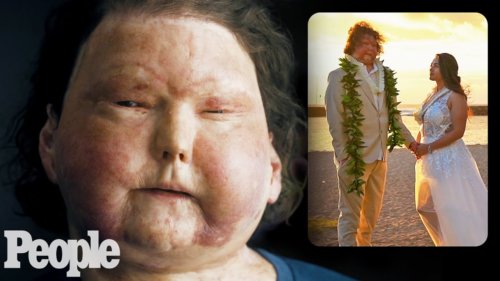 I Survived a Face Transplant — Then Met the Love of My Life | PEOPLE